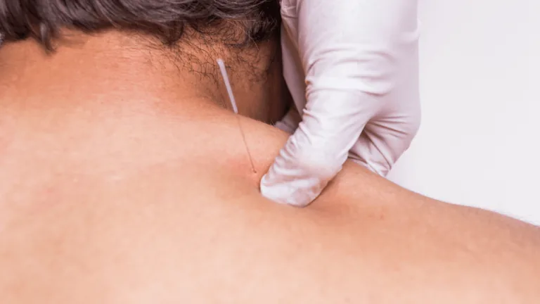 Dry needling treatment for trigger point pain relief, Berwick